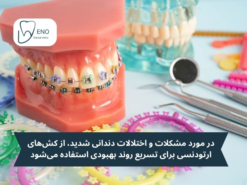 الاستیکهای ارتودنسی