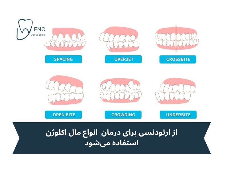 انواع مال اکلوژن