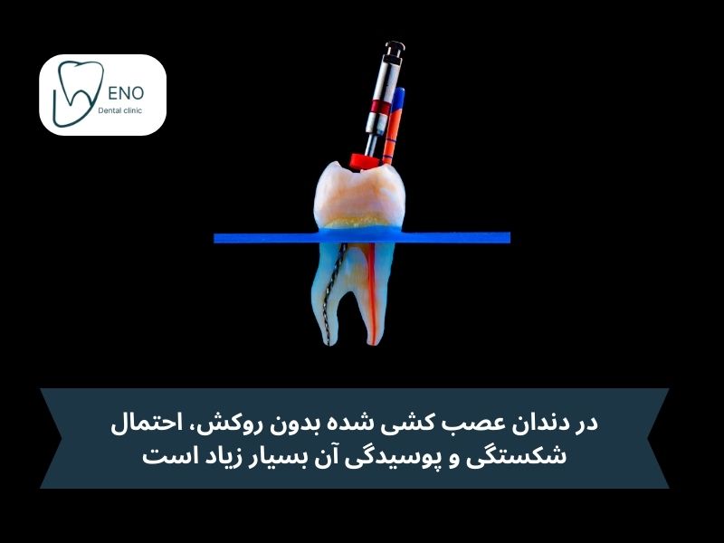 اگر دندان عصب کشی شده روکش نشود چه میشود؟