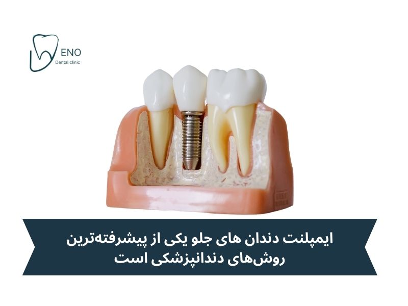ایمپلنت دندان جلو چیست؟