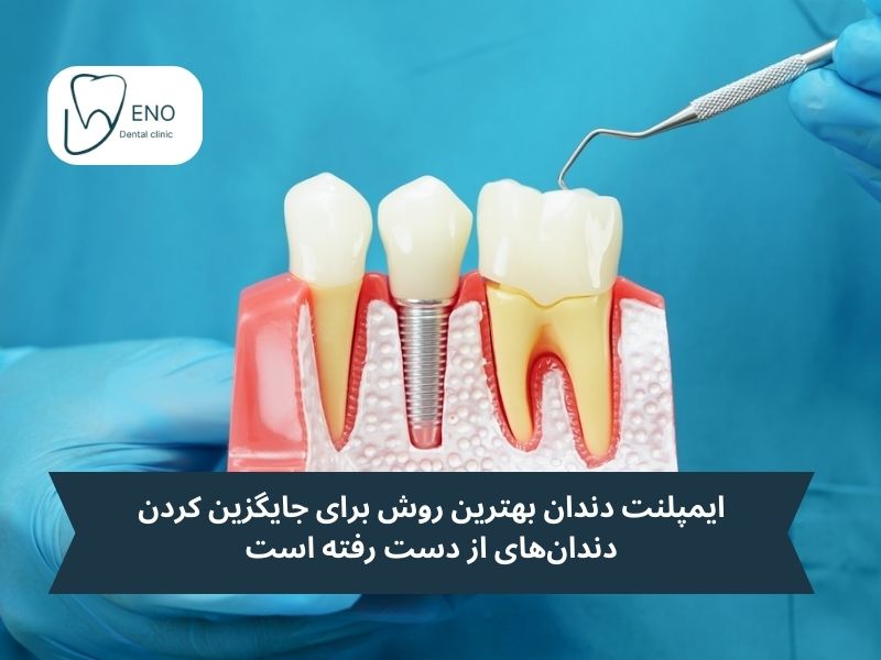 ایمپلنت دندان در طراحی لبخند