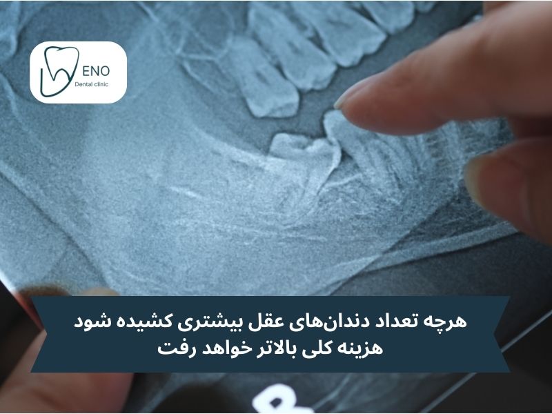 تعداد دندان عقل مورد نظر و تاثیرش بر قیمت