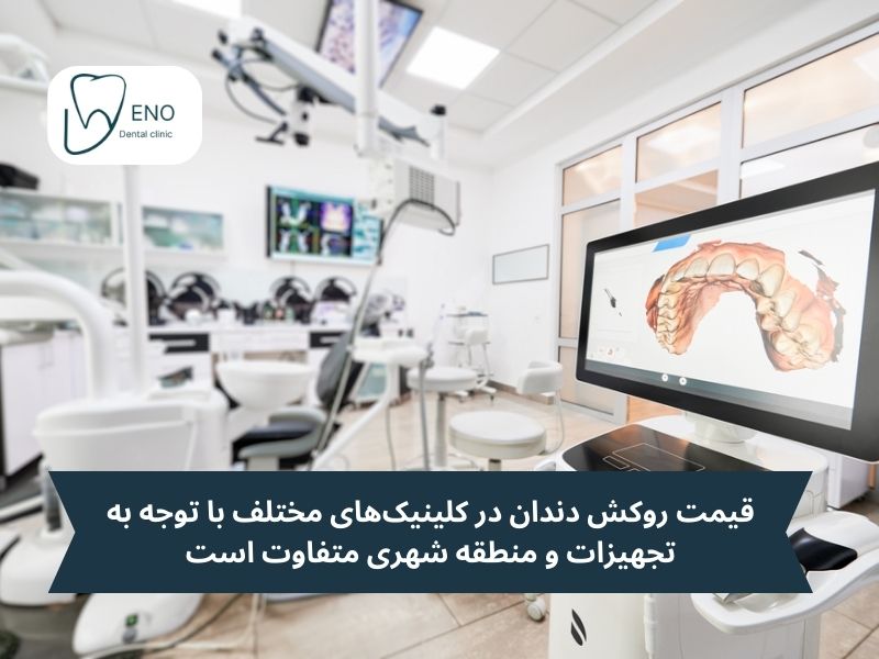 تفاوت قیمت روکش دندان در کشور و مناطق مختلف