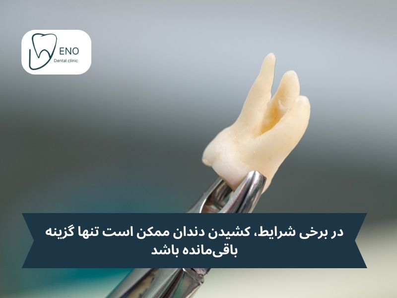 در این شرایط، کشیدن دندان ممکن است تنها گزینه باقیمانده باشد