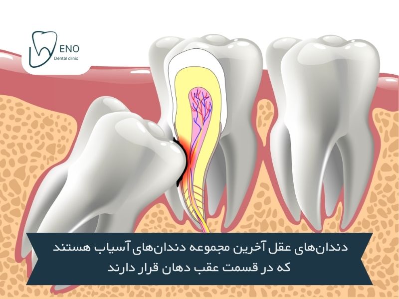 دندان عقل چیست