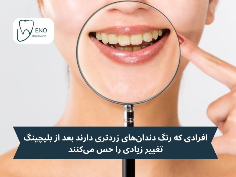 رنگ طبیعی دندانها و بلیچینگ