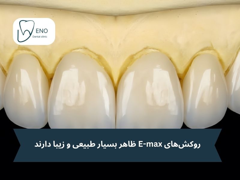 روکشهای E-max