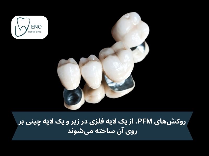 روکشهای PFM؛ گزینه اقتصادی و مناسب برای روکش دندان عصب کشی شده