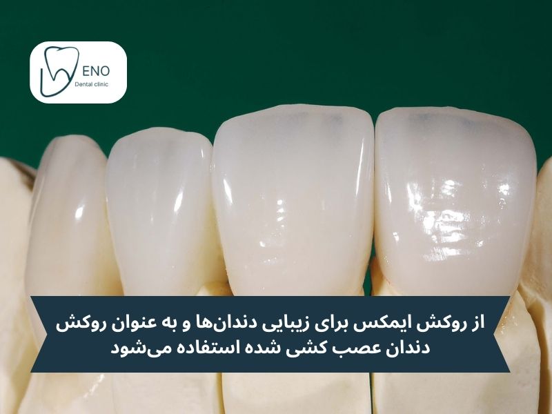 روکش ایمکس