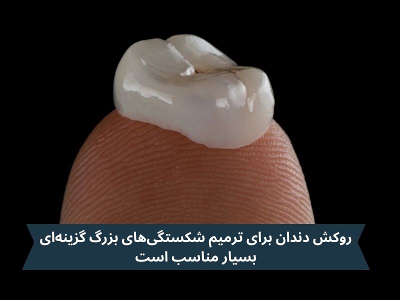 روکش دندان برای ترمیم شکستگیهای بزرگ و بازگرداندن استحکام و عملکرد دندان به ویژه در دندانهای پشتی، گزینهای بسیار مناسب است