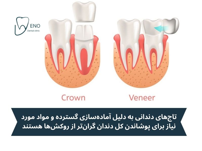 روکش دندان گرانتر است یا تاج
