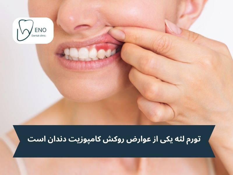 عوارض کامپوزیت دندان