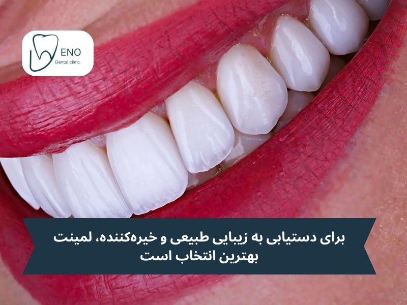 فرق لمینت و کامپوزیت در زیبایی و ظاهر