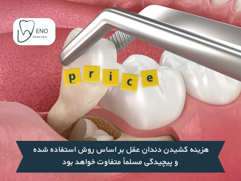 قیمت جراحی دندان عقل بر اساس نوع کشیدن