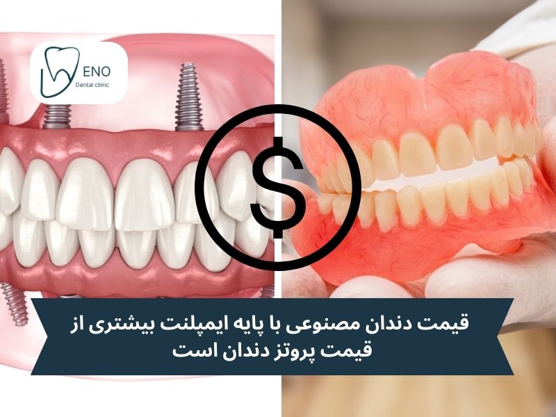 قیمت دندان مصنوعی مناسبتر است یا دندان مصنوعی بر پایه ایمپلنت