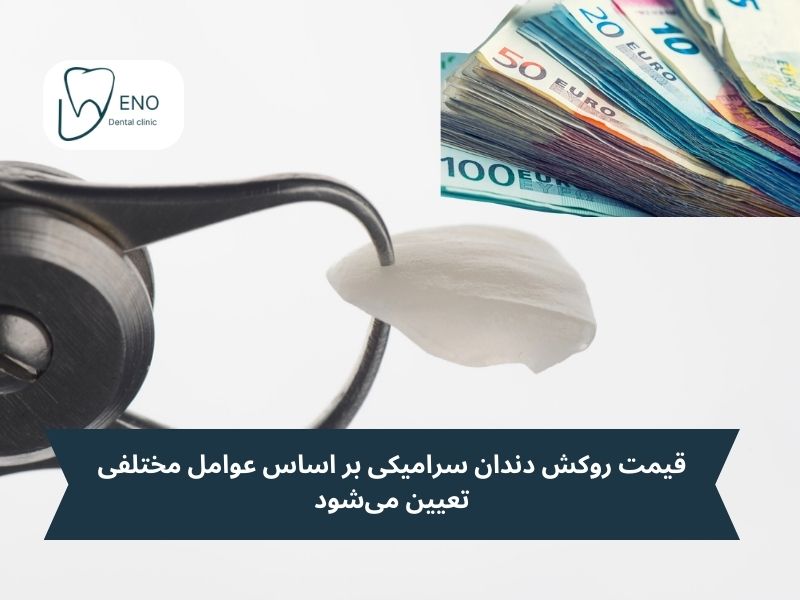قیمت روکش دندان سرامیکی