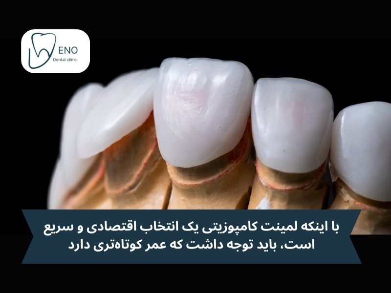 لمینت کامپوزیتی؛ راهحلی اقتصادی و سریع