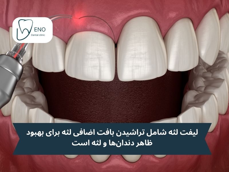 لیفت لثه