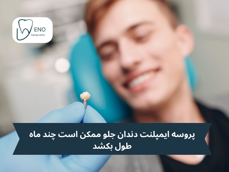 مراحل ایمپلنت دندان جلو؛ ایمپلنت دندان جلو چگونه است؟