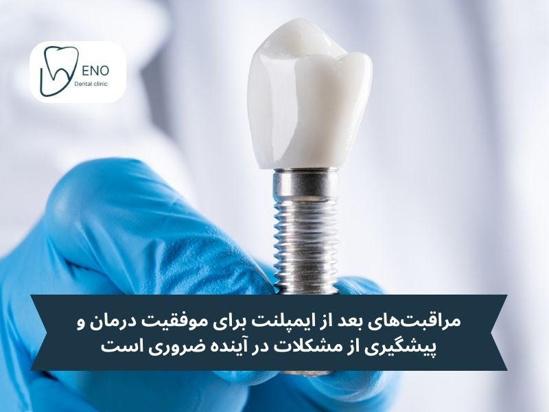 مراقبتهای بعد از ایمپلنت دندان جلو