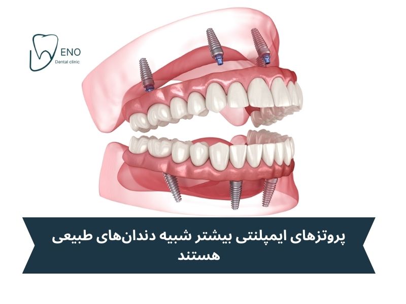 مزایای انتخاب دندان مصنوعی بر پایه ایمپلنت