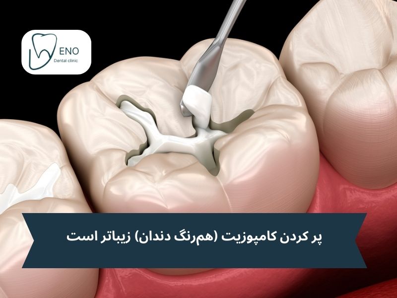 مزایای انواع پر کردن دندان