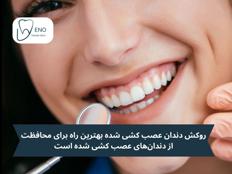 مزایا و معایب روکش دندان عصب کشی شده در یک نگاه