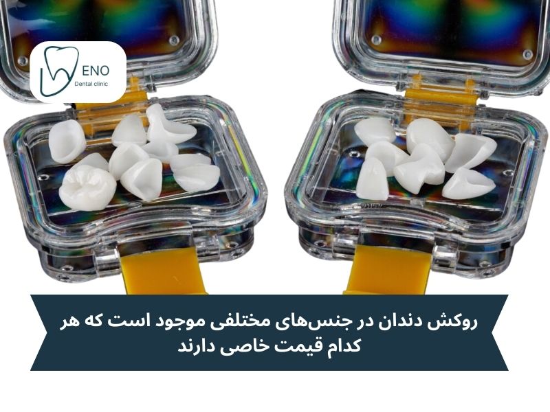 نوع مواد انتخابی برای روکش دندان