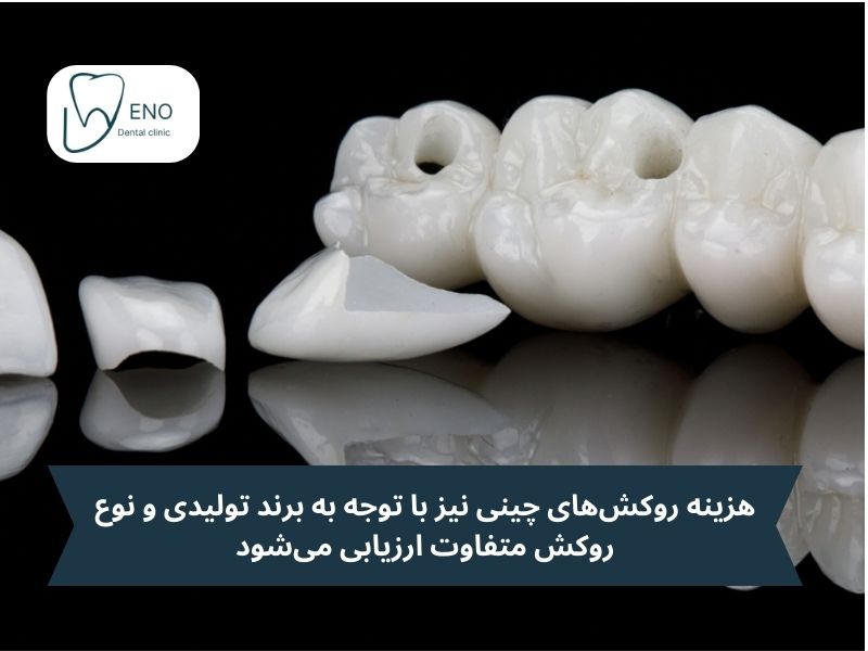 هزینه روکشهای چینی