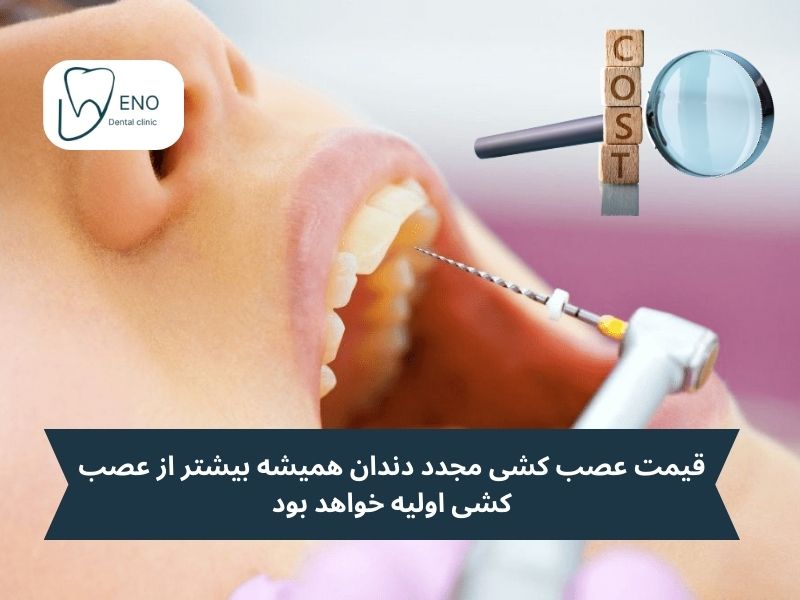 هزینه عصب کشی مجدد دندان