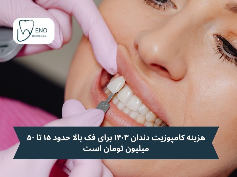 هزینه کامپوزیت دندان ۱۴۰۳ برای فک بالا