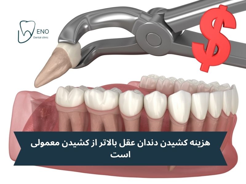 هزینه کشیدن دندان عقل