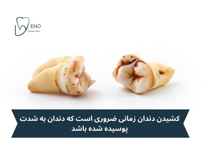 پوسیدگی شدید و ضرورت کشیدن دندان