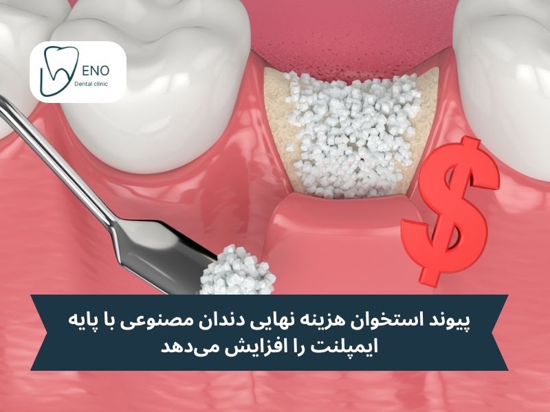 پیوند استخوان و افزایش هزینه دندان مصنوعی با پایه ایمپلنت