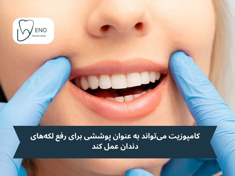 چه زمانی به ترمیم کامپوزیت دندان نیاز داریم؟