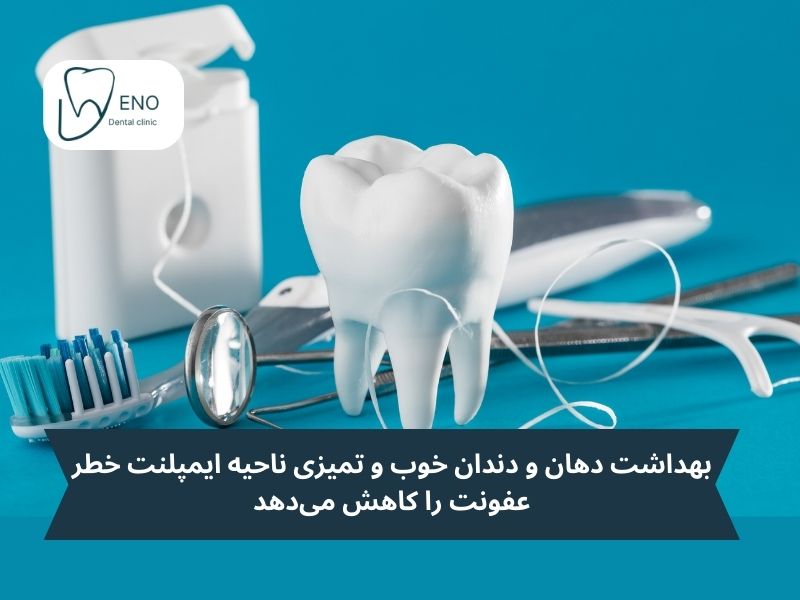 اهمیت مراقبت های بعد از ایمپلنت دندانی چیست