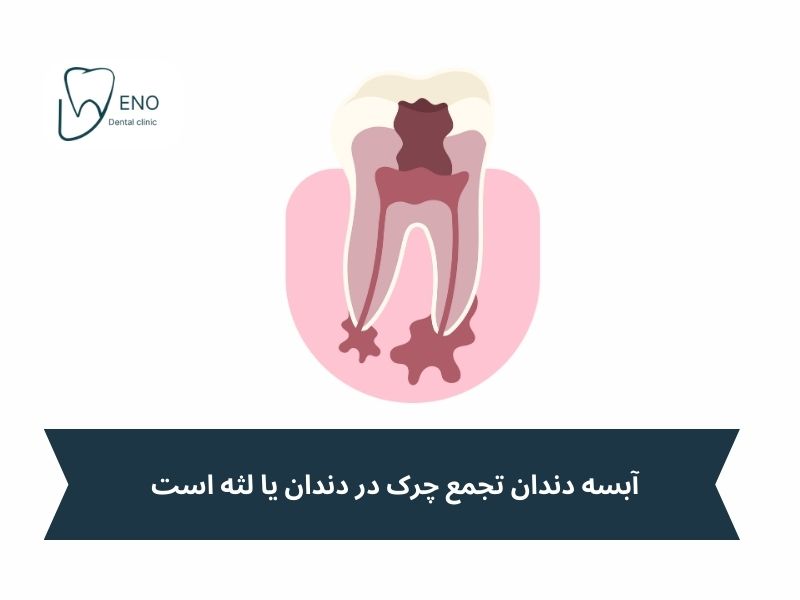 آبسه دندان چیست