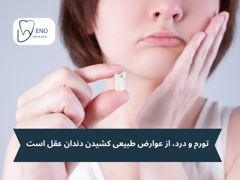 آشنایی با عوارض طبیعی کشیدن دندان عقل