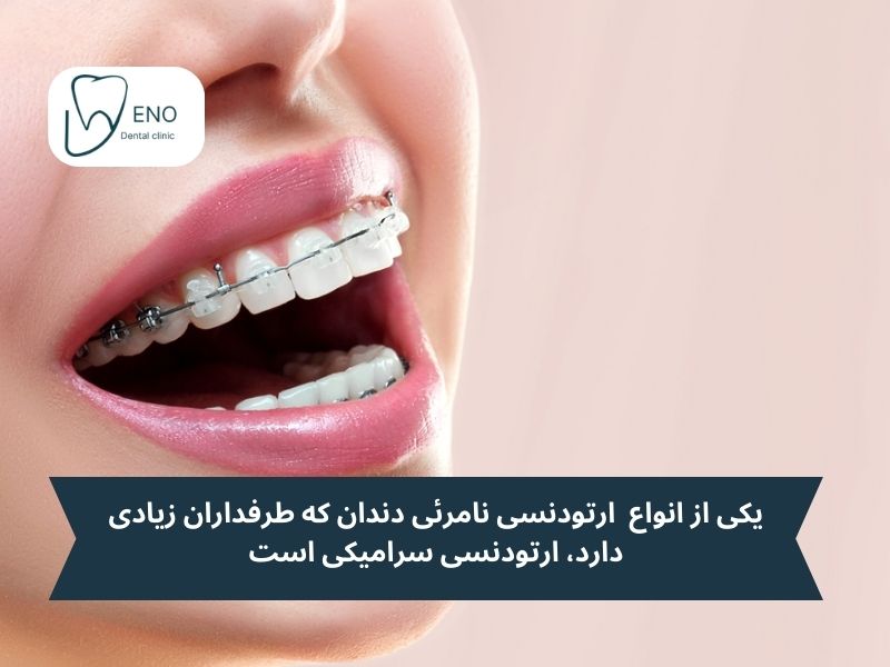براکتهای سرامیکی