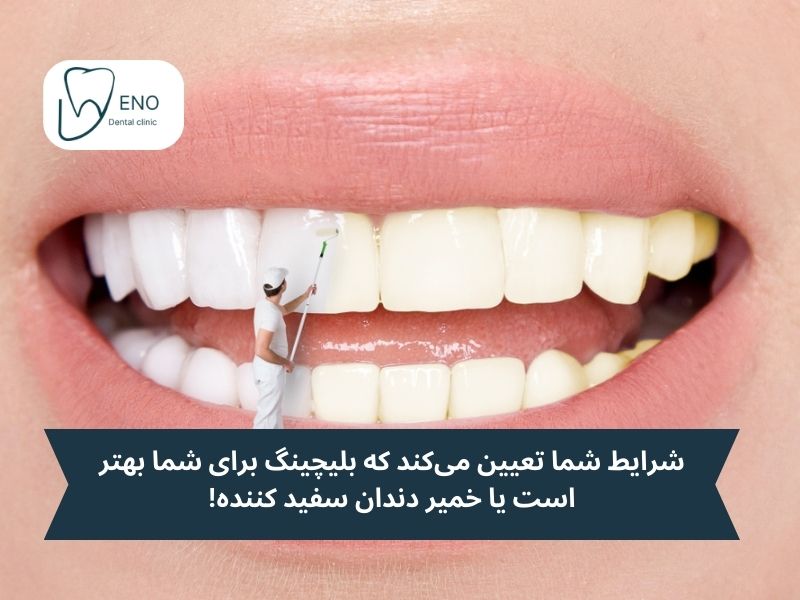 بلیچینگ دندان یا خمیر دندان سفید کننده دندان