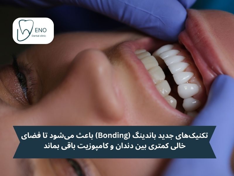 تاثیر تکنولوژیهای جدید در کاهش خطر پوسیدگی دندان زیر کامپوزیت
