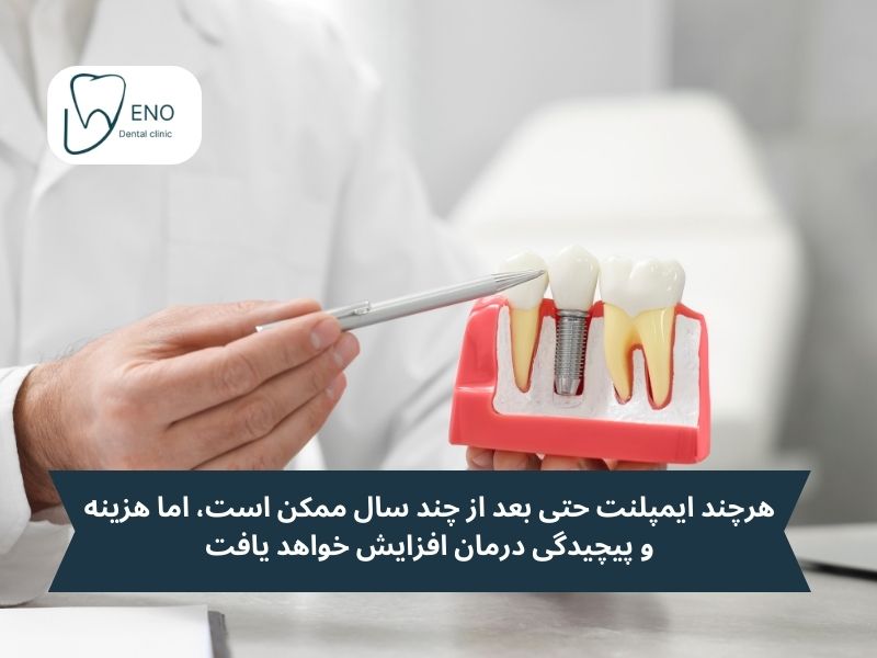تا چند سال بعد از کشیدن دندان میتوان ایمپلنت کرد؟
