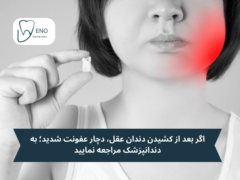 عفونت دندان بعد از کشیدن دندان عقل
