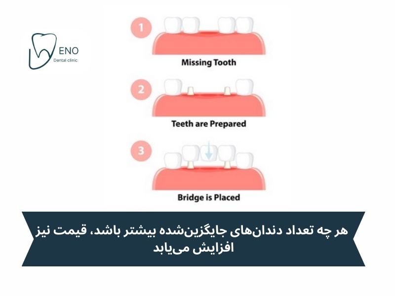 قیمت بریج دندان چگونه محاسبه میشود؟