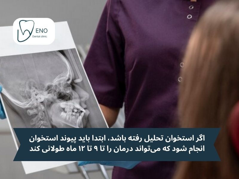 مدت زمان ایمپلنت بعد از کشیدن دندان