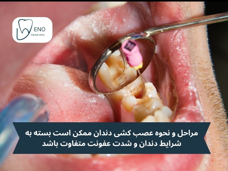 مراحل عصب کشی دندان