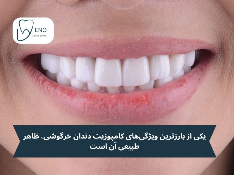 مزایای کامپوزیت دندان خرگوشی