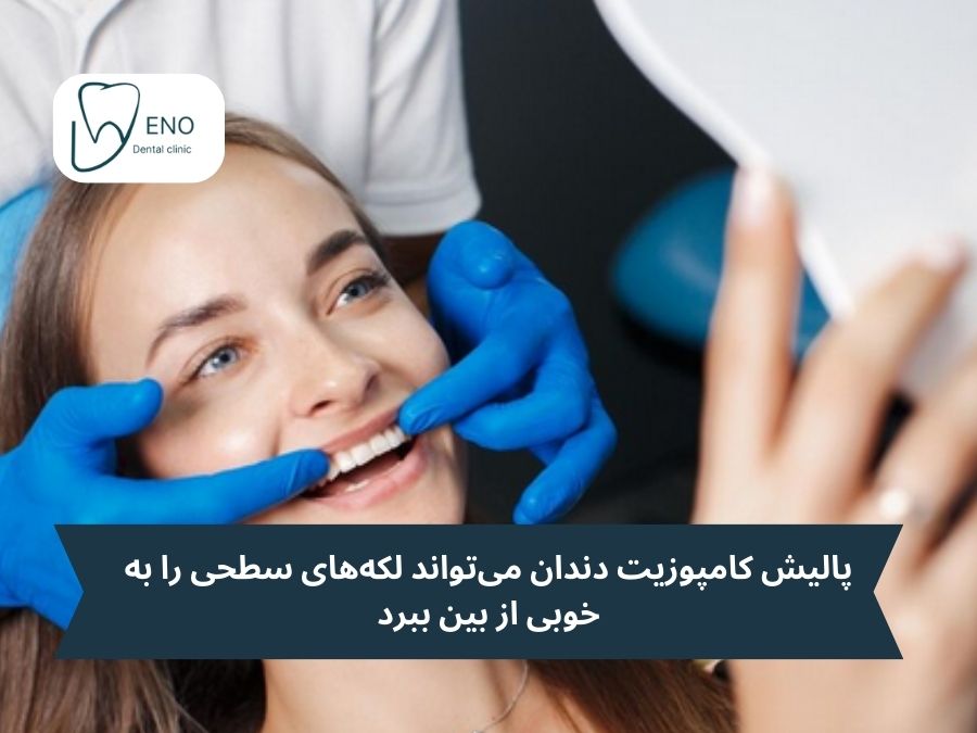 معایب و محدودیتهای پالیش دندان بعد از کامپوزیت