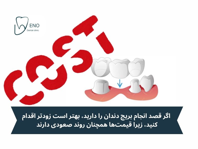 مقایسه قیمت بریج دندان ۱۴۰۳ با چند سال قبل؛ علت گرانی چیست