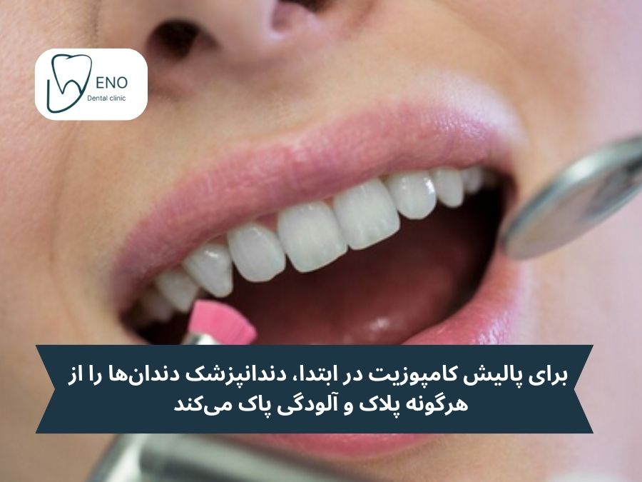 نحوه پالیش کامپوزیت دندان